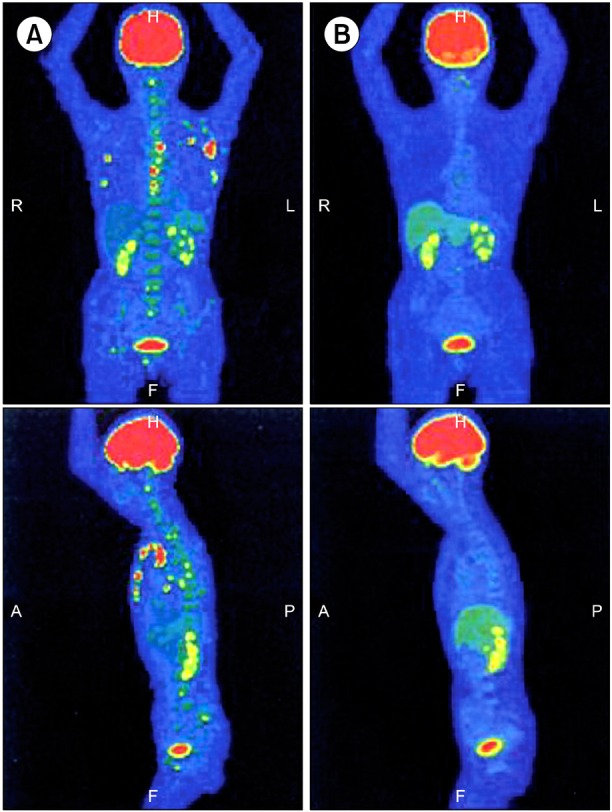 Successful treatment of diffuse large B-cell lymphoma with clarithromycin and prednisolone.