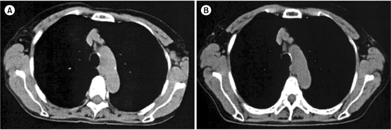 Successful treatment of diffuse large B-cell lymphoma with clarithromycin and prednisolone.