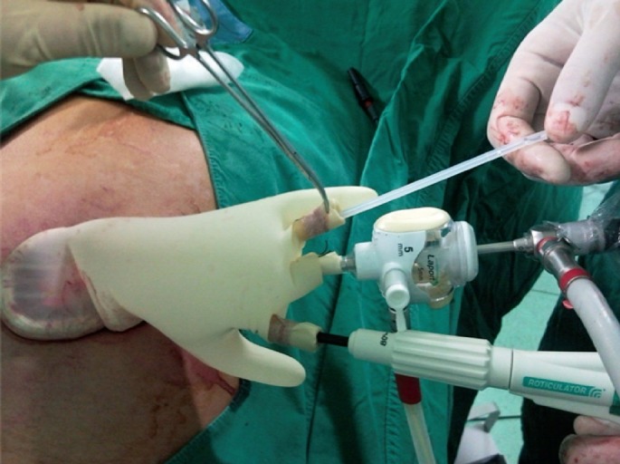 Comparative study of a single-incision laparoscopic and a conventional laparoscopic appendectomy for the treatment of acute appendicitis.