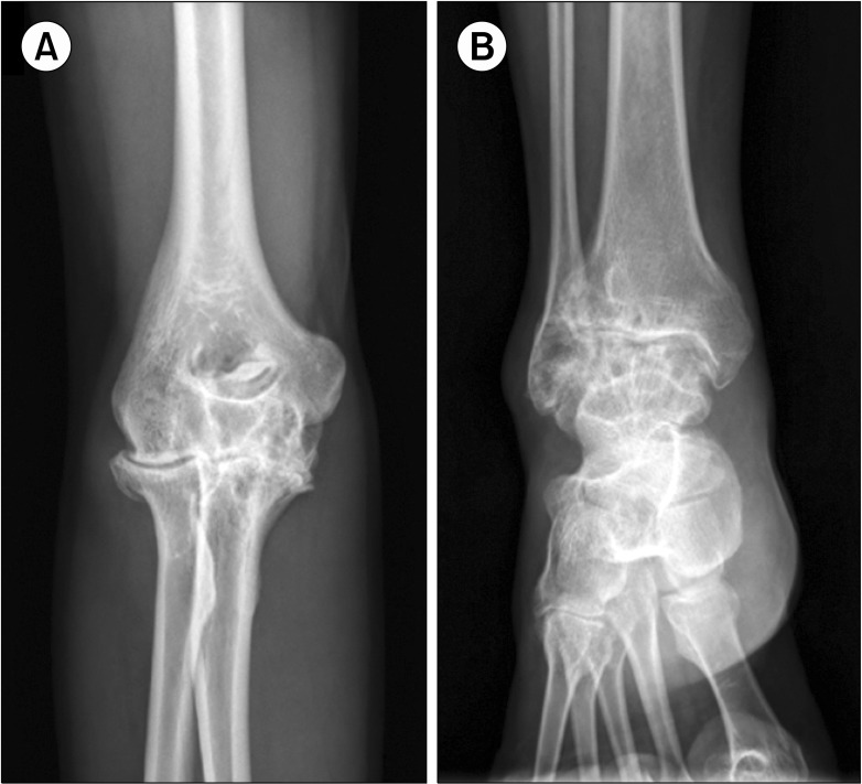 Surgery in patients with congenital factor VII deficiency: A single center experience.