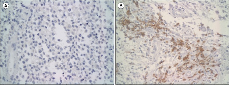 Prognostic significance of gelsolin and MMP12 in Langerhans cell histiocytosis.