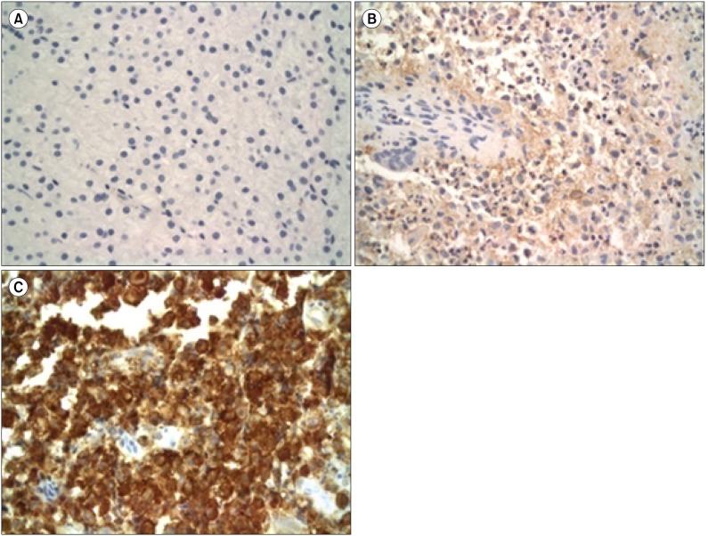 Prognostic significance of gelsolin and MMP12 in Langerhans cell histiocytosis.