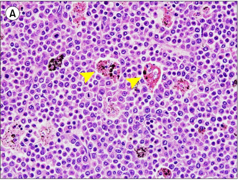 Primary myelofibrosis and extramedullary blastic transformation with hemophagocytosis.