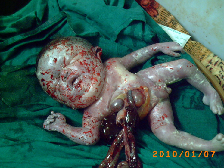 Report of three cases of unusual anterior abdominal wall defects in fallujah general hospital during the year 2010.