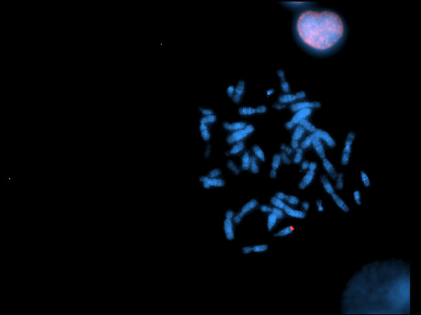 Absence of subtelomeric rearrangements in selected patients with mental retardation as assessed by multiprobe T FISH.