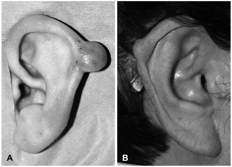 Clinical characteristics of auricular keloids treated with surgical excision.