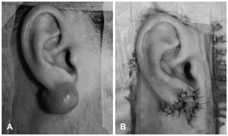 Clinical characteristics of auricular keloids treated with surgical excision.