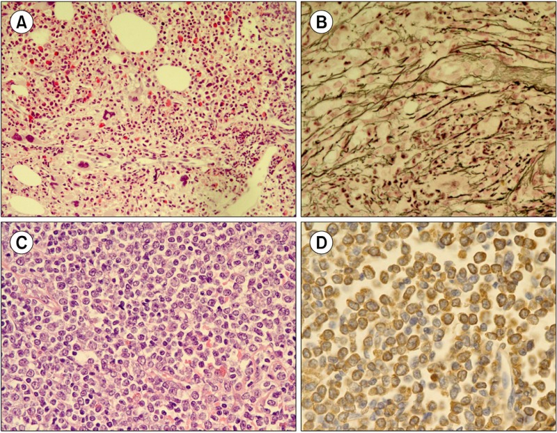 Extramedullary blast crisis of secondary CML accompanying marrow fibrosis.