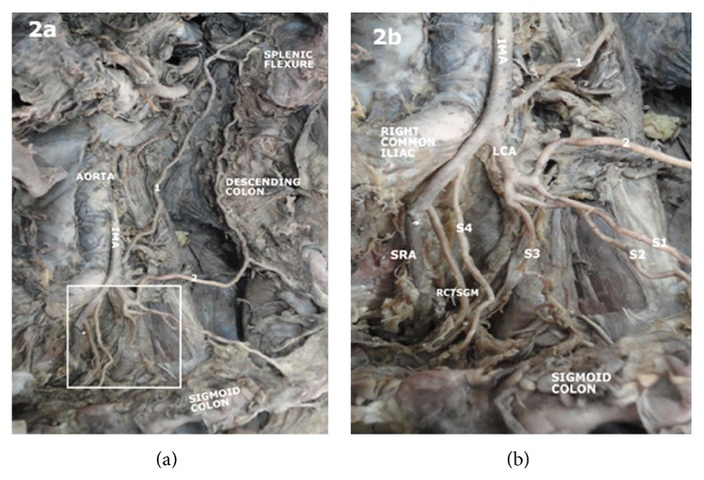 Branching pattern of inferior mesenteric artery in a black african population: a dissection study.