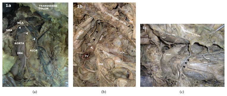 Branching pattern of inferior mesenteric artery in a black african population: a dissection study.