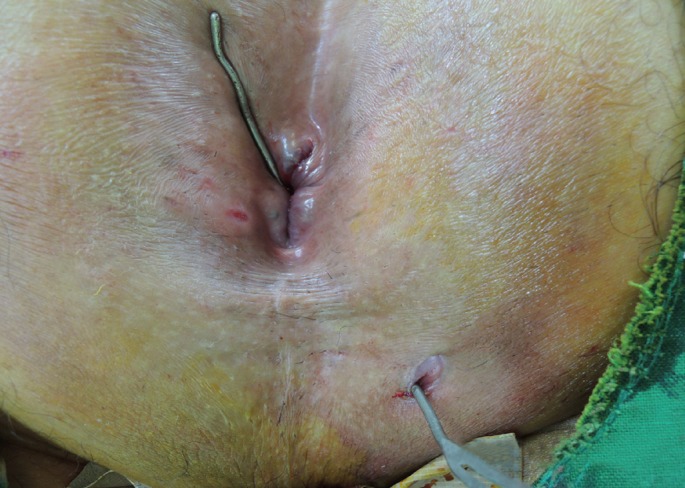 The use of a staged drainage seton for the treatment of anal fistulae or fistulous abscesses.