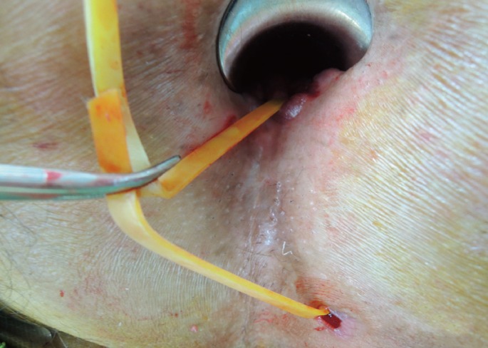 The use of a staged drainage seton for the treatment of anal fistulae or fistulous abscesses.