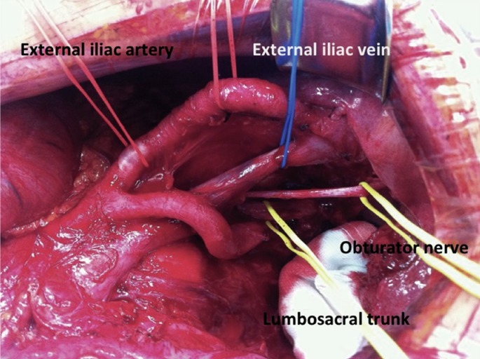 Pelvic exenteration: surgical approaches.