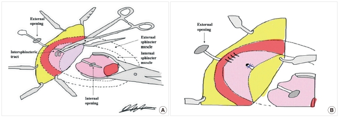 New techniques for treating an anal fistula.