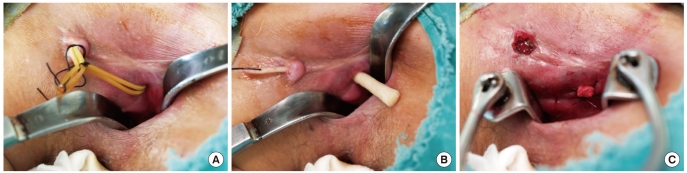 New techniques for treating an anal fistula.