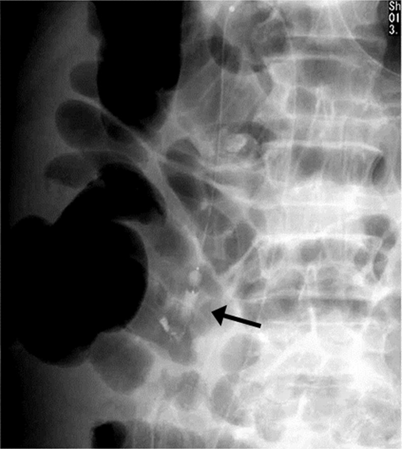 Successful treatment of ruptured duodenal varices with dual balloon-occluded embolotherapy.