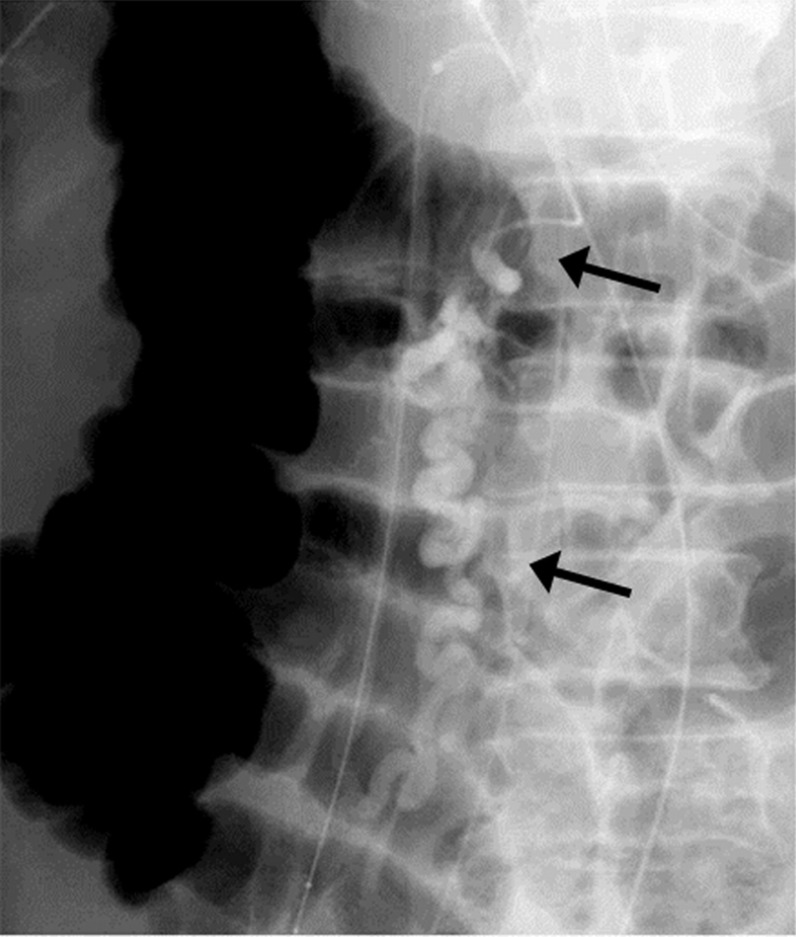 Successful treatment of ruptured duodenal varices with dual balloon-occluded embolotherapy.