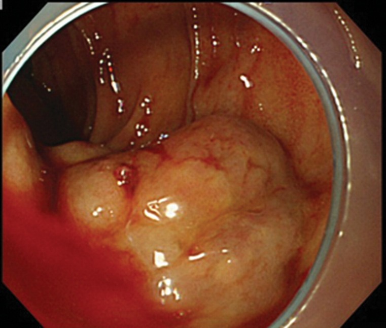 Successful treatment of ruptured duodenal varices with dual balloon-occluded embolotherapy.