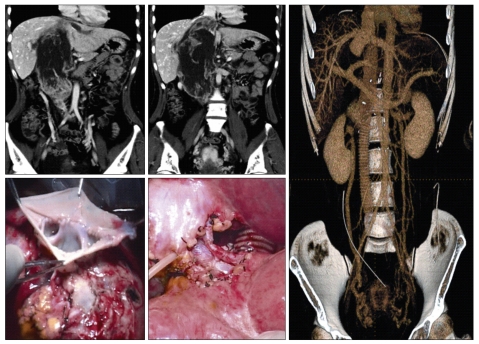 Multidisciplinary treatment and long-term outcomes in six patients with leiomyosarcoma of the inferior vena cava.