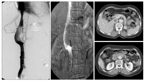 Multidisciplinary treatment and long-term outcomes in six patients with leiomyosarcoma of the inferior vena cava.