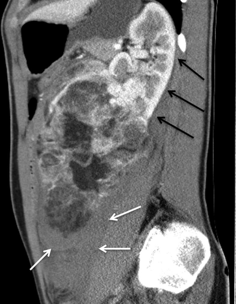 Massive retroperitoneal hemorrhage from a giant renal angiomyolipoma treated by selective arterial embolization with an Amplatzer Vascular Plug II.