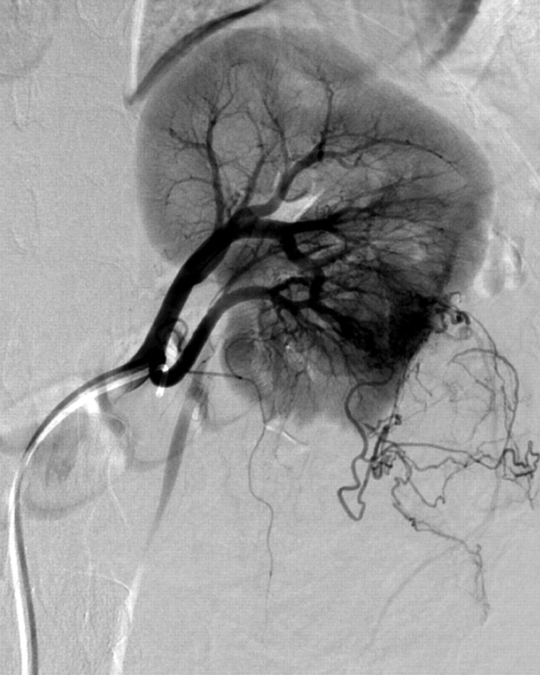 Massive retroperitoneal hemorrhage from a giant renal angiomyolipoma treated by selective arterial embolization with an Amplatzer Vascular Plug II.