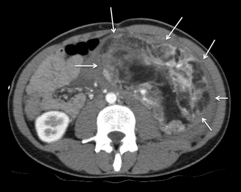 Massive retroperitoneal hemorrhage from a giant renal angiomyolipoma treated by selective arterial embolization with an Amplatzer Vascular Plug II.