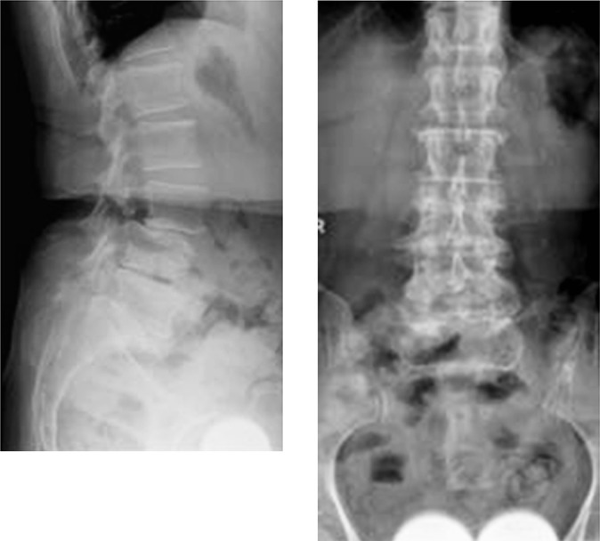 Acute spinal subdural hematoma complicating lumbar decompressive surgery.