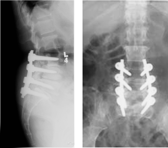 Acute spinal subdural hematoma complicating lumbar decompressive surgery.