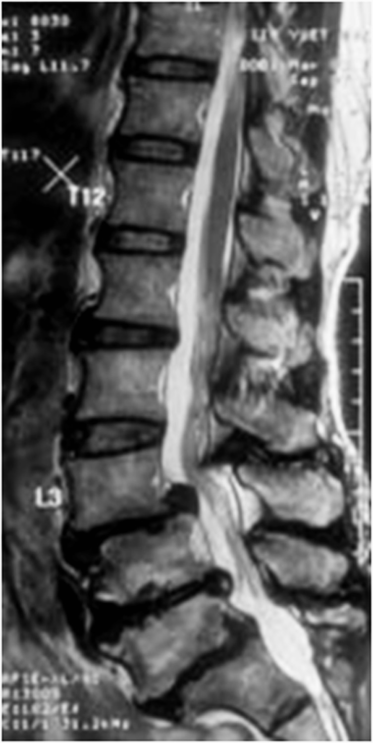 Acute spinal subdural hematoma complicating lumbar decompressive surgery.