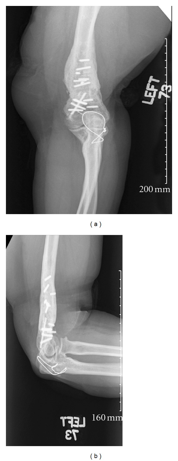 Late removal of titanium hardware from the elbow is problematic.