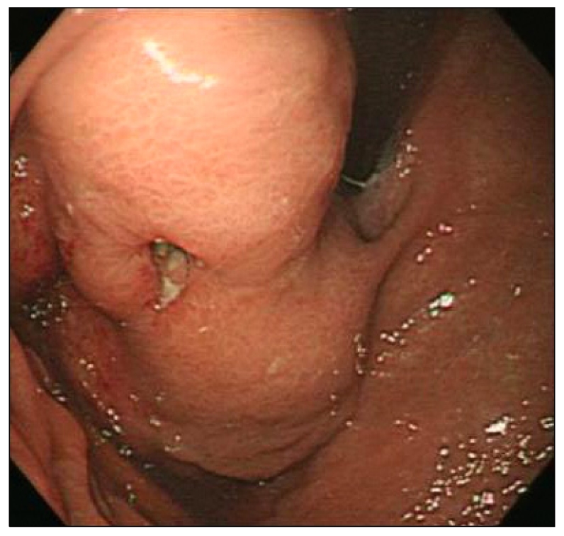 Clinicopathologic change of gastrointestinal stromal tumor after neoadjuvant imatinib followed by surgical resection.