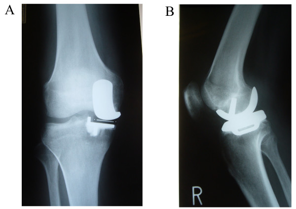 Arthroscopic observation was useful to detect loosening of the femoral component of unicompartmental knee arthroplasty in a recurrent hemoarthrosis.