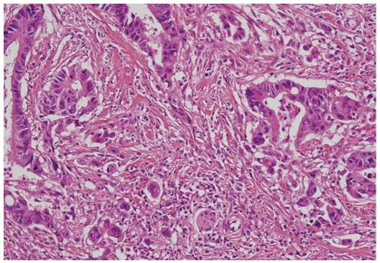 Clinicopathologic factors affecting recurrence after curative surgery for stage I colorectal cancer.