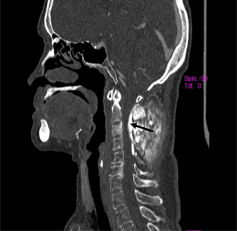 Unusual cause of neuropathy: extensive dural spread of primary cervical osteosarcoma.