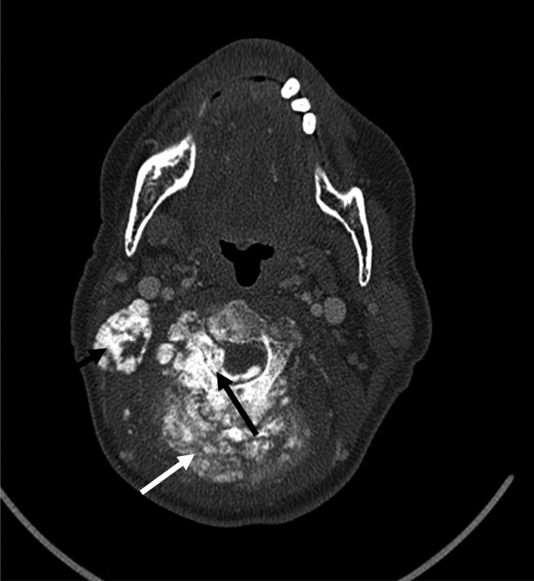 Unusual cause of neuropathy: extensive dural spread of primary cervical osteosarcoma.