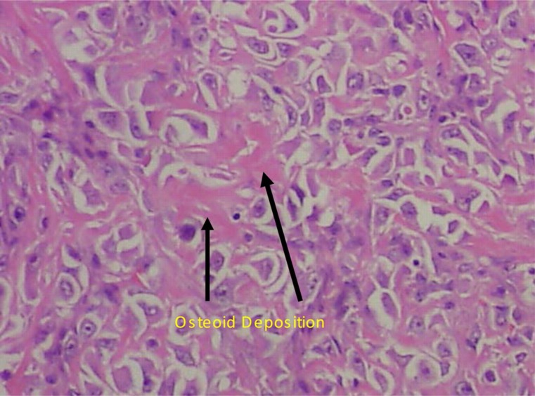 Unusual cause of neuropathy: extensive dural spread of primary cervical osteosarcoma.