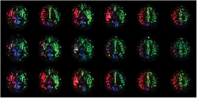 Dynamic alteration of regional cerebral blood flow during carotid compression and proof of reversibility.
