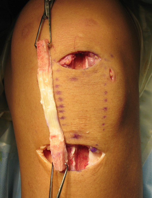 Arthroscopic anatomical double-bundle anterior cruciate ligament reconstruction for asian patient using a bone-patellar tendon-bone and gracilis tendon composite autograft: a technical note.