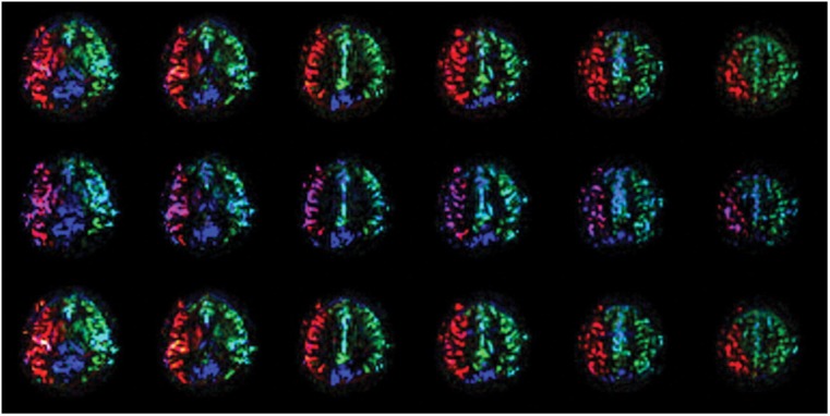 Dynamic alteration of regional cerebral blood flow during carotid compression and proof of reversibility.