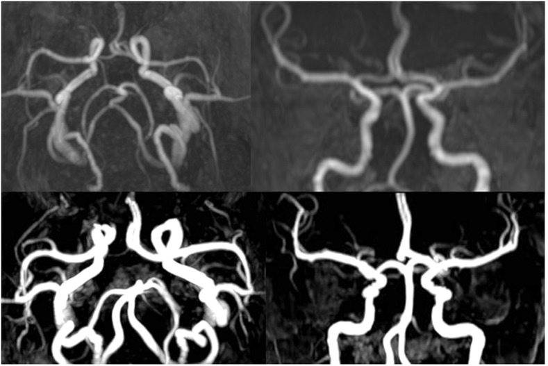 Dynamic alteration of regional cerebral blood flow during carotid compression and proof of reversibility.