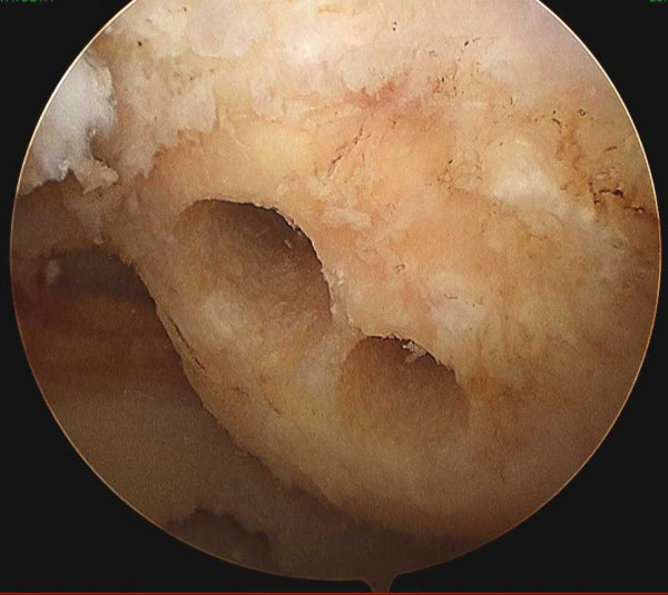 Arthroscopic anatomical double-bundle anterior cruciate ligament reconstruction for asian patient using a bone-patellar tendon-bone and gracilis tendon composite autograft: a technical note.