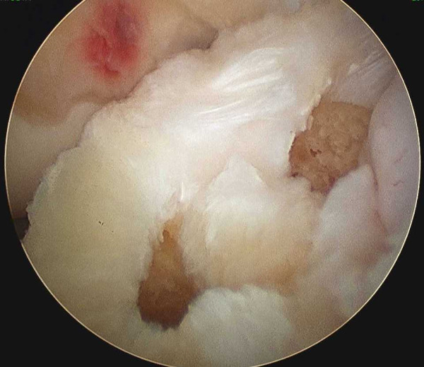 Arthroscopic anatomical double-bundle anterior cruciate ligament reconstruction for asian patient using a bone-patellar tendon-bone and gracilis tendon composite autograft: a technical note.