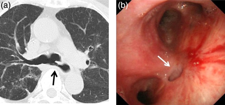 Successful closure of intractable tracheoesophageal fistula using a combination of a modified silicon stent and metallic stents.