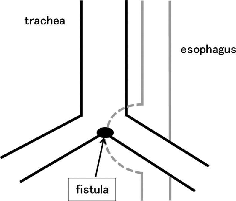 Successful closure of intractable tracheoesophageal fistula using a combination of a modified silicon stent and metallic stents.