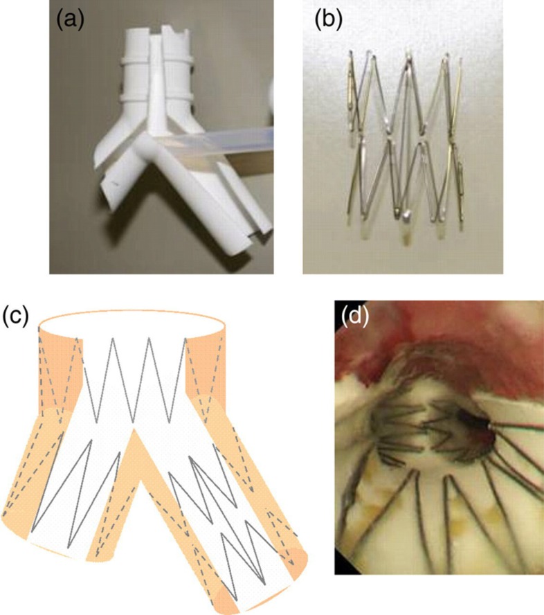 Successful closure of intractable tracheoesophageal fistula using a combination of a modified silicon stent and metallic stents.