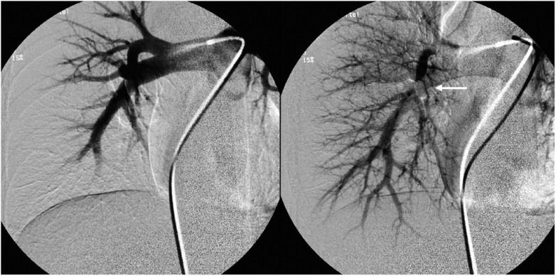 Embolization of pulmonary AVMs of feeding arteries less than 3 mm: reports of two cases and an 8-year follow-up without embolization.