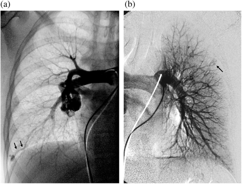 Embolization of pulmonary AVMs of feeding arteries less than 3 mm: reports of two cases and an 8-year follow-up without embolization.