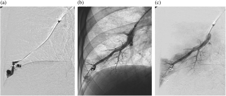 Embolization of pulmonary AVMs of feeding arteries less than 3 mm: reports of two cases and an 8-year follow-up without embolization.