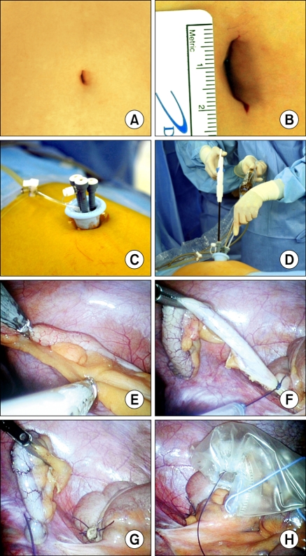 Pain after laparoscopic appendectomy: a comparison of transumbilical single-port and conventional laparoscopic surgery.